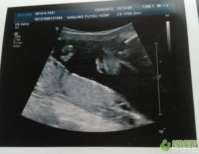 淮北妇幼保健院做nt挂什么科